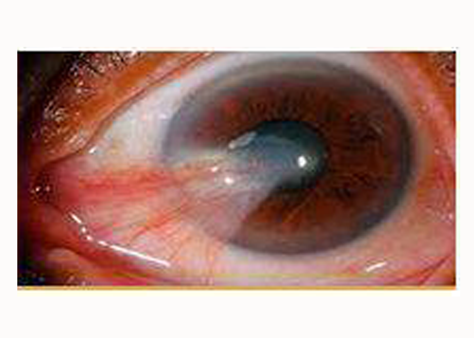 Glaucoma